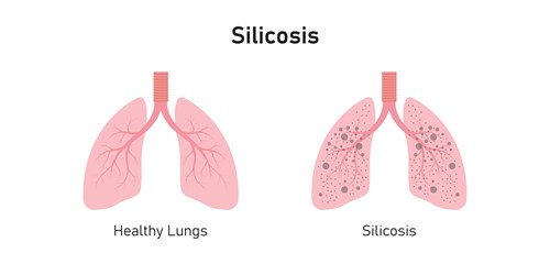 two lungs, one showing healthy set and another that has silicosis causing breathing problems and breathing difficulties if inhaled.