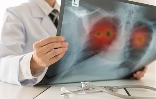 A doctor holding an X-ray of lungs showing signs of asbestos exposure.