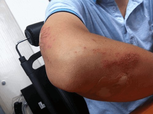 A person with a rash on their arm.